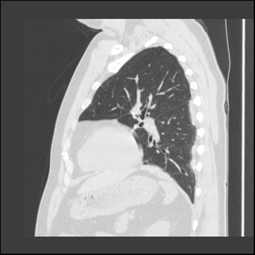 Asbestosis (Radiopaedia 45002-48961 Sagittal lung window 41).jpg