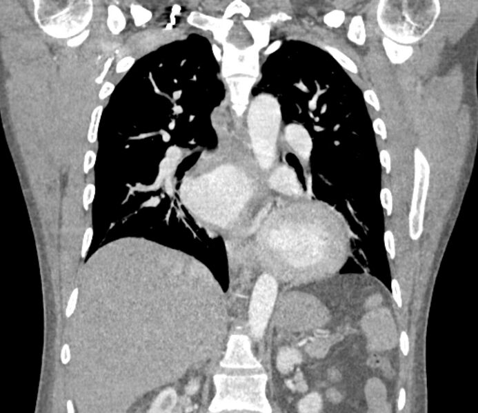 File:Ascending aortic aneurysm (Radiopaedia 86279-102297 B 41).jpg