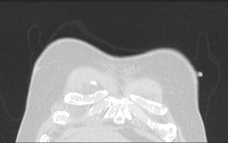 File:Aspirated tooth (Radiopaedia 28584-28844 Axial lung window 21).jpg