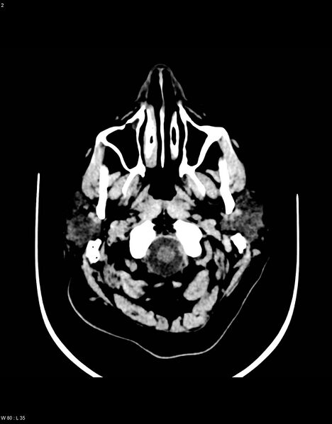 File:Astroblastoma (Radiopaedia 39792-42216 Axial non-contrast 1).jpg