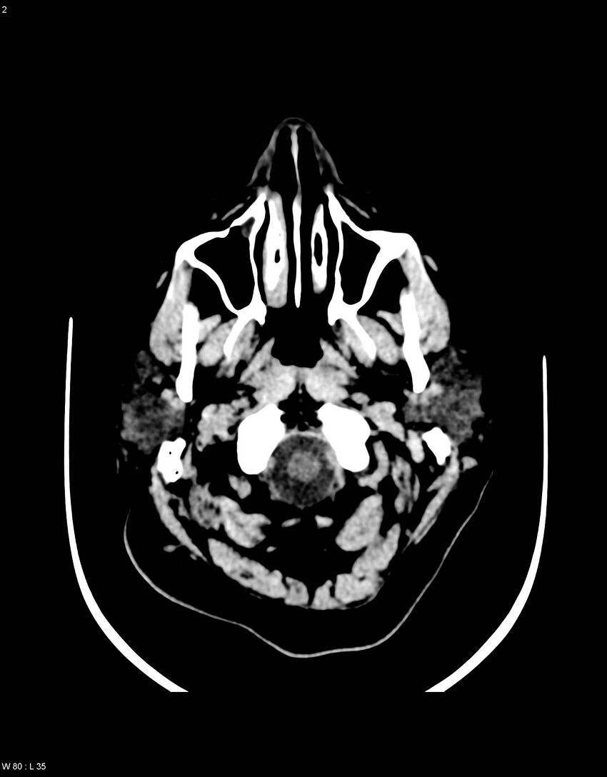 Astroblastoma (Radiopaedia 39792-42216 Axial non-contrast 1).jpg