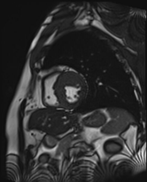 File:Asymmetric septal hypertrophic cardiomyopathy - systolic anterior motion of mitral leaflet (Radiopaedia 72795-83445 C 23).jpg
