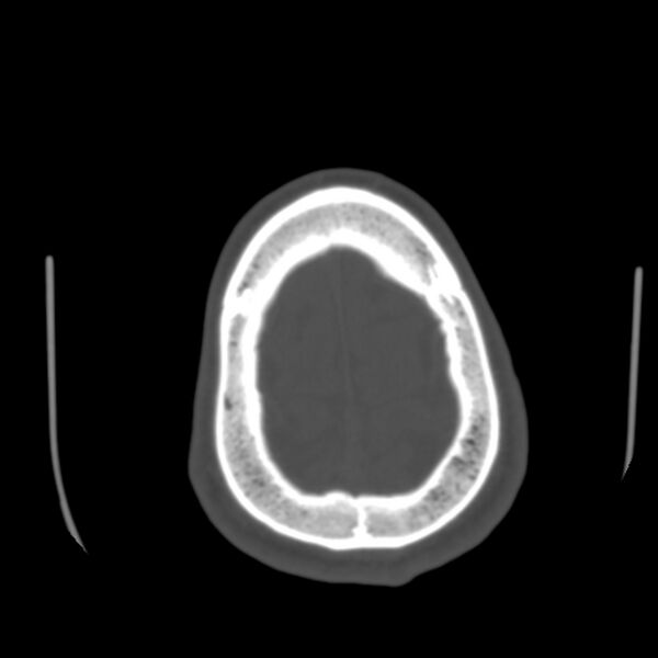 File:Asymptomatic occipital spur (Radiopaedia 87753-104201 Axial bone window 191).jpg