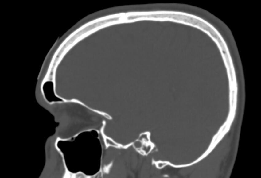 Asymptomatic occipital spur (Radiopaedia 87753-104201 Sagittal bone window 100).jpg