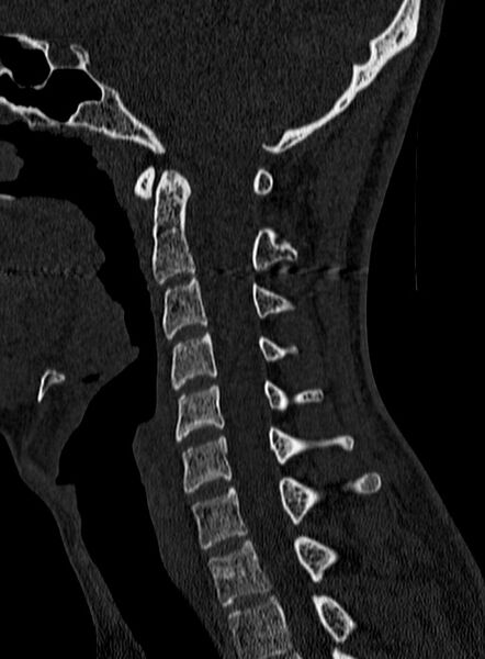 File:Atlantoaxial subluxation (Radiopaedia 44681-48450 Sagittal bone window 69).jpg