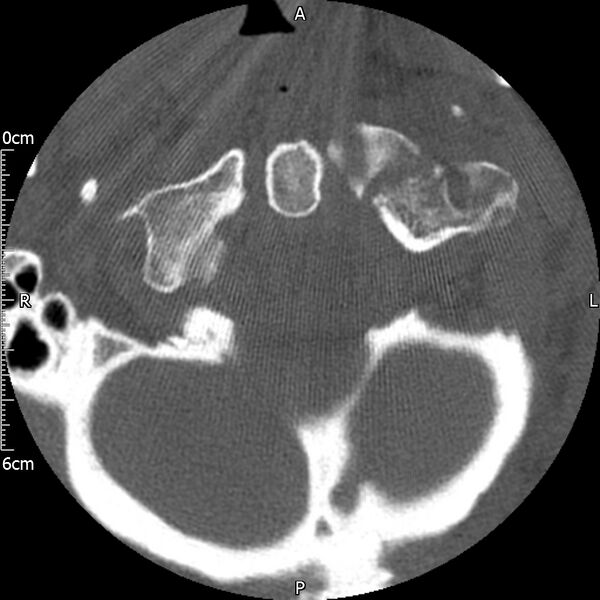 File:Atlas fracture with Currarino type A congenital defect (Radiopaedia 71747-82144 Axial bone window 33).jpg