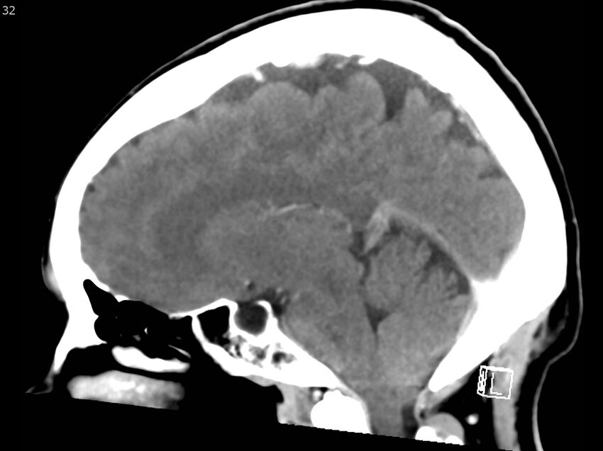 Atypical meningioma - intraosseous (Radiopaedia 64915-73867 F 31).jpg