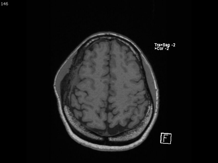 Atypical meningioma - intraosseous (Radiopaedia 64915-74572 Axial T1 146).jpg