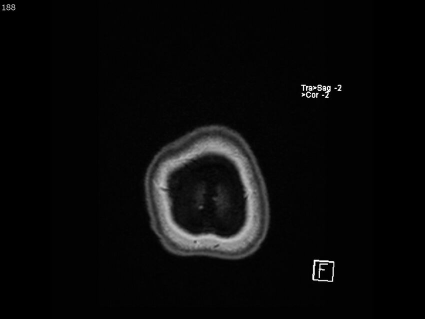 Atypical meningioma - intraosseous (Radiopaedia 64915-74572 Axial T1 188).jpg