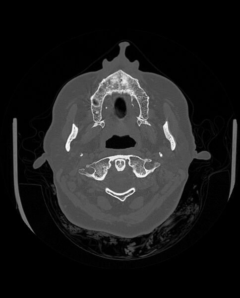 File:Automastoidectomy with labyrinthine fistula (Radiopaedia 84143-99411 Axial non-contrast 38).jpg