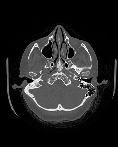 File:Automastoidectomy with labyrinthine fistula (Radiopaedia 84143-99411 Axial non-contrast 73).jpg