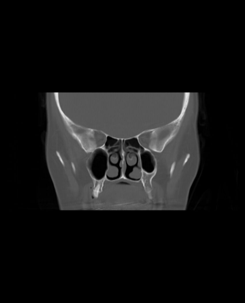 Automastoidectomy with labyrinthine fistula (Radiopaedia 84143-99411 Coronal non-contrast 45).jpg