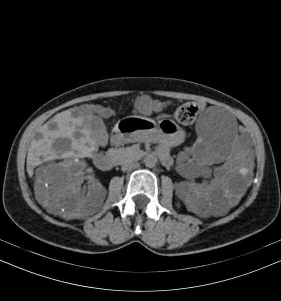 File:Autosomal dominant polycystic kidney disease (Radiopaedia 41918-44922 Axial non-contrast 14).jpg