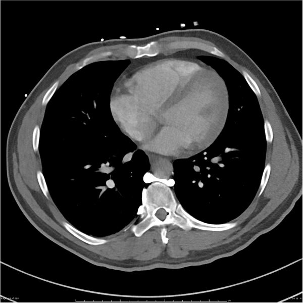 File:Azygos venous system anatomy (CT pulmonary angiography) (Radiopaedia 25928-26077 Axial C+ CTPA 58).jpg