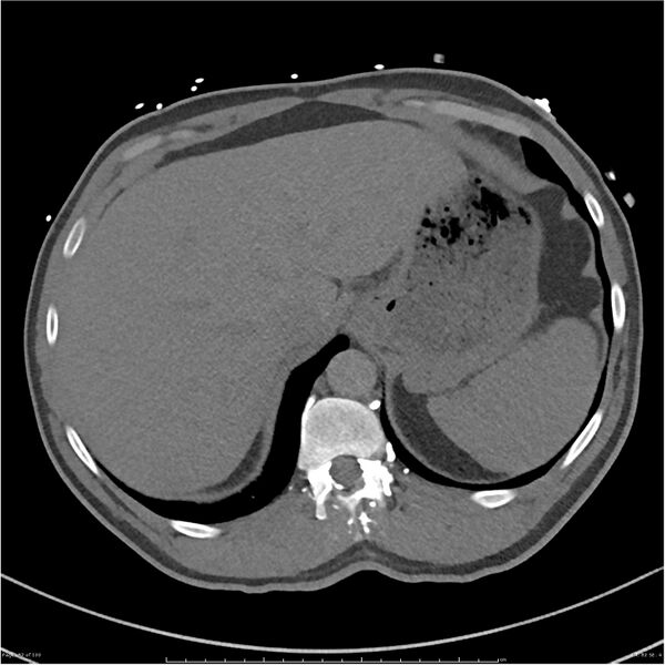 File:Azygos venous system anatomy (CT pulmonary angiography) (Radiopaedia 25928-26077 Axial C+ CTPA 82).jpg