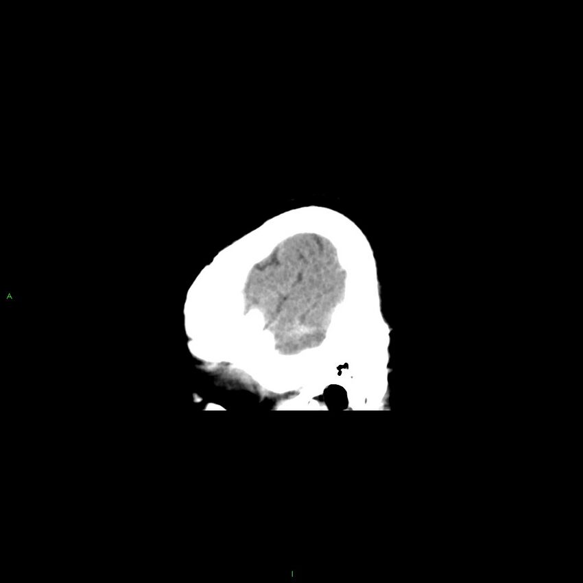 Basal ganglia hemorrhage (Radiopaedia 58349-65472 C 5).jpg
