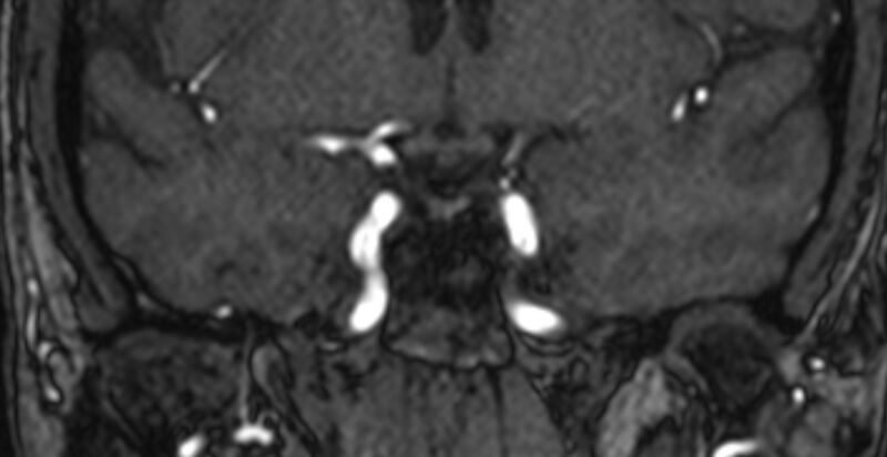 File:Basilar artery fenestration (Radiopaedia 74537-85455 Coronal MRA TOF 21).jpg