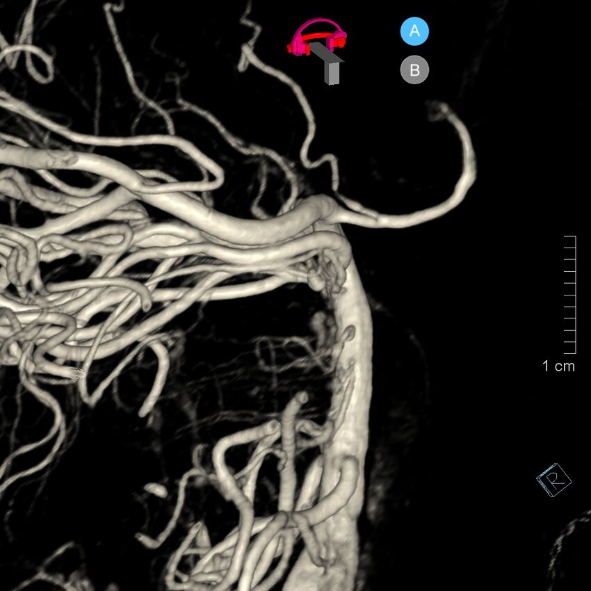 Basilar artery perforator aneurysm (Radiopaedia 82455-97734 3D view left VA 138).jpg