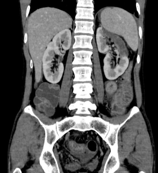 File:Behçet's disease- abdominal vasculitis (Radiopaedia 55955-62570 B 42).jpg