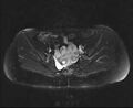 Bicornuate bicollis uterus (Radiopaedia 61626-69616 Axial PD fat sat 15).jpg