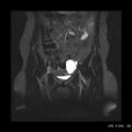 Bicornuate uterus- on MRI (Radiopaedia 49206-54297 Coronal STIR 4).jpg