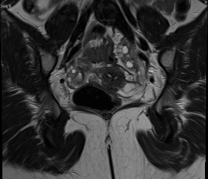 File:Bicornuate uterus (Radiopaedia 71214-81511 Coronal T2 12).jpg