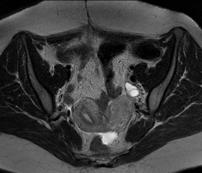 File:Bicornuate uterus (Radiopaedia 76407-88114 Axial T2 9).jpg