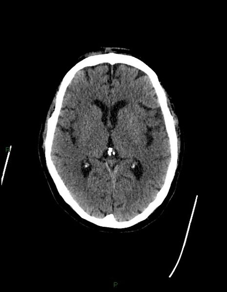 File:Bilateral acute middle cerebral artery territory infarcts (Radiopaedia 77319-89401 Axial non-contrast 43).jpg
