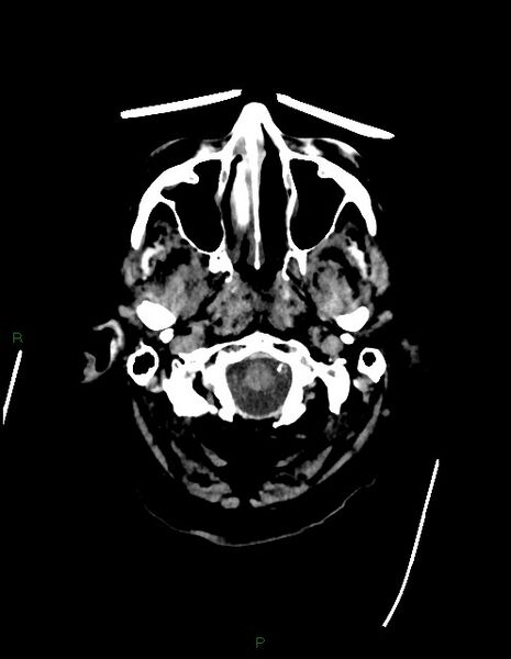 File:Bilateral acute middle cerebral artery territory infarcts (Radiopaedia 77319-89401 Axial non-contrast 5).jpg