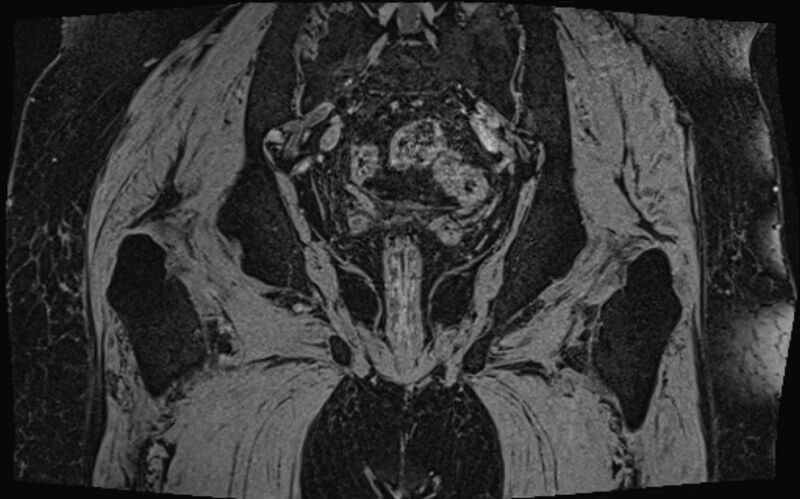 File:Bilateral avascular necrosis of femoral head (Radiopaedia 77116-89078 Coronal T2 we 8).jpg