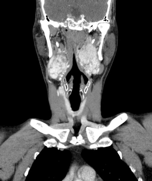 File:Bilateral carotid body tumors (Radiopaedia 52899-58827 B 15).jpg