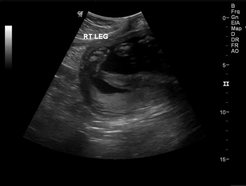 File:Bilateral congenital talipes equino-varus deformity in fetus (Radiopaedia 23337-23412 D 1).jpg