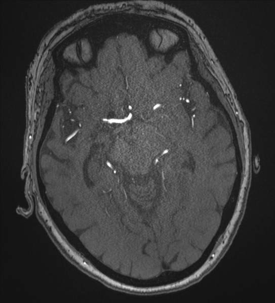 File:Bilateral fetal posterior communicating arteries (Radiopaedia 41286-44102 Axial MRA 91).png