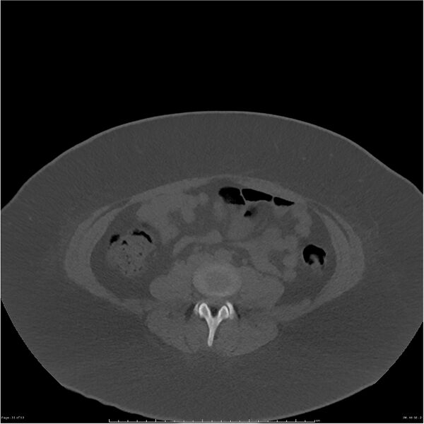 File:Bilateral lumbar ribs (Radiopaedia 25862-26010 bone window 31).jpg