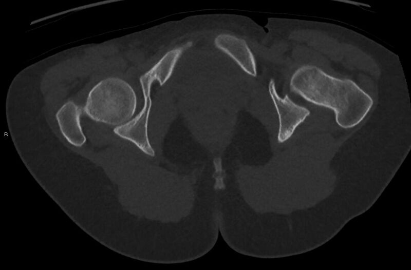 File:Bilateral mature cystic ovarian teratoma (Radiopaedia 88821-105592 Axial bone window 58).jpg