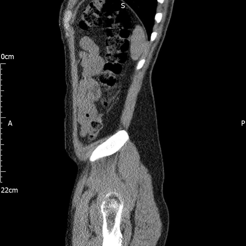 Bilateral medullary nephrocalcinosis with ureteric calculi (Radiopaedia 71269-81569 C 22).jpg