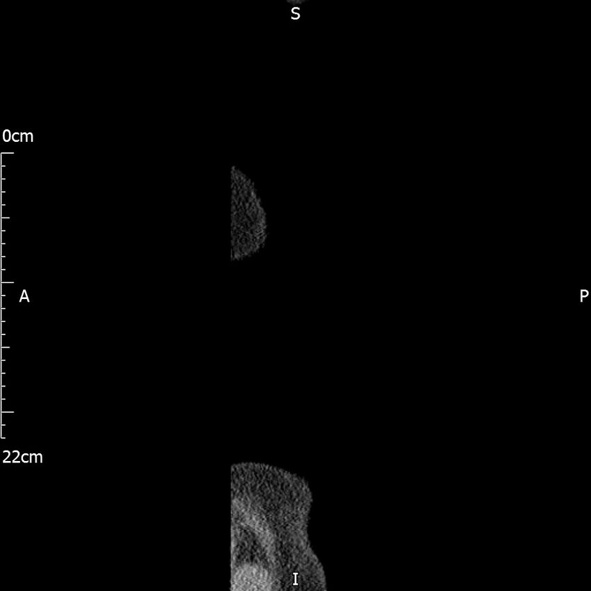 Bilateral medullary nephrocalcinosis with ureteric calculi (Radiopaedia 71269-81569 C 4).jpg