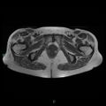 Bilateral ovarian fibroma (Radiopaedia 44568-48293 Axial T1 26).jpg