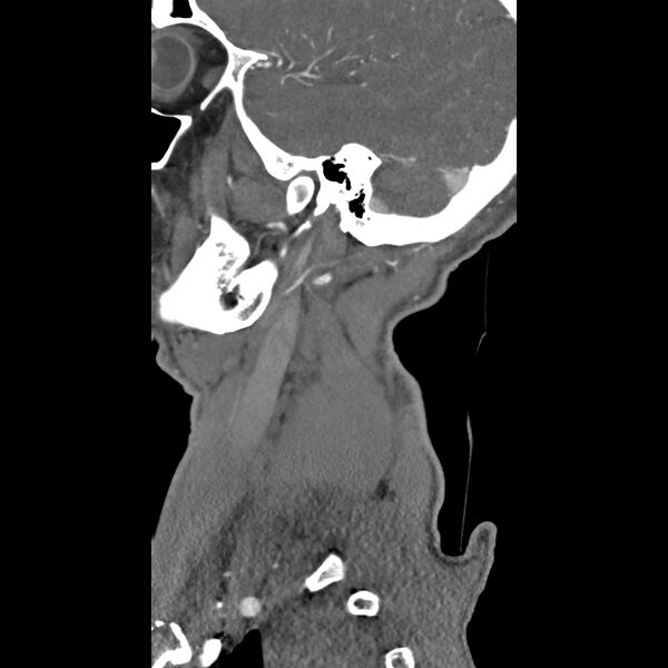 File:Bilateral perched facets with cord injury (Radiopaedia 45587-49713 B 2).jpg