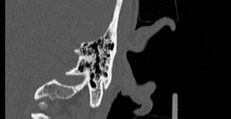 File:Bilateral temporal bone fractures (Radiopaedia 29482-29970 B 87).jpg