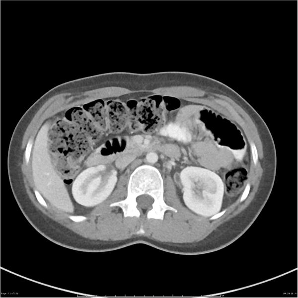 File:Bilateral ureteritis and cystitis (Radiopaedia 25340-25594 A 28).jpg
