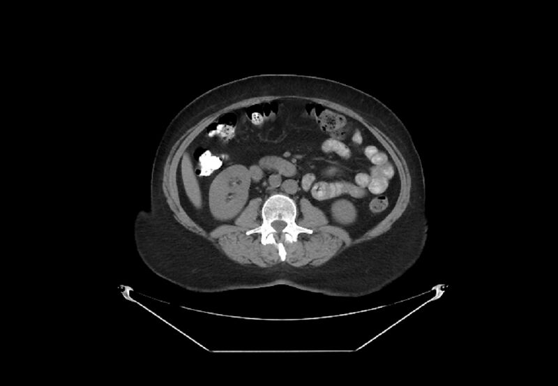 File:Bilateral urolithiasis with incidentally detected splenic artery aneurysm and left inferior vena cava (Radiopaedia 44467-48123 Axial non-contrast 27).jpg