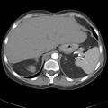 Biliary necrosis - liver transplant (Radiopaedia 21876-21845 A 12).jpg