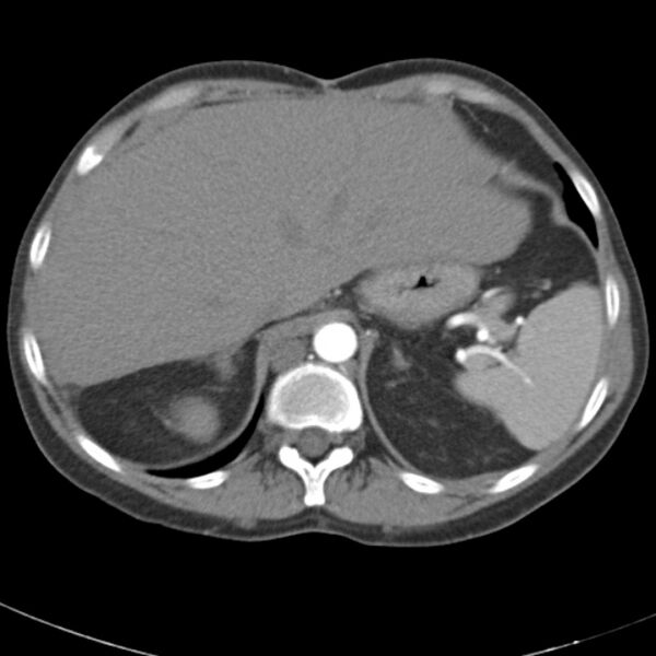 File:Biliary necrosis - liver transplant (Radiopaedia 21876-21845 A 12).jpg