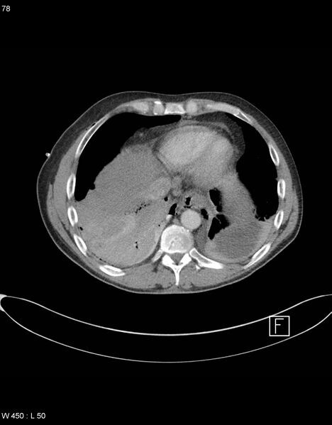 File:Boerhaave syndrome with tension pneumothorax (Radiopaedia 56794-63605 A 38).jpg