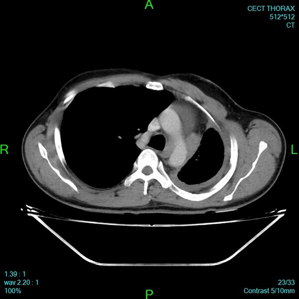 File:Bone metastases from lung carcinoma (Radiopaedia 54703-60937 Axial C+ delayed 23).jpg