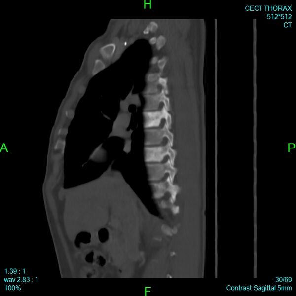 File:Bone metastases from lung carcinoma (Radiopaedia 54703-60937 Sagittal bone window 30).jpg