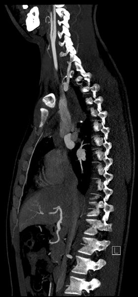File:Brachiocephalic trunk pseudoaneurysm (Radiopaedia 70978-81191 C 41).jpg