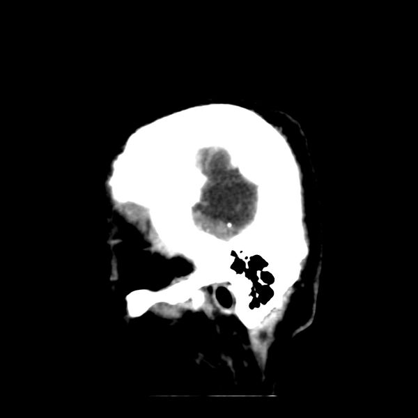 File:Brain Pantopaque remnants (Radiopaedia 78403-91048 C 5).jpg