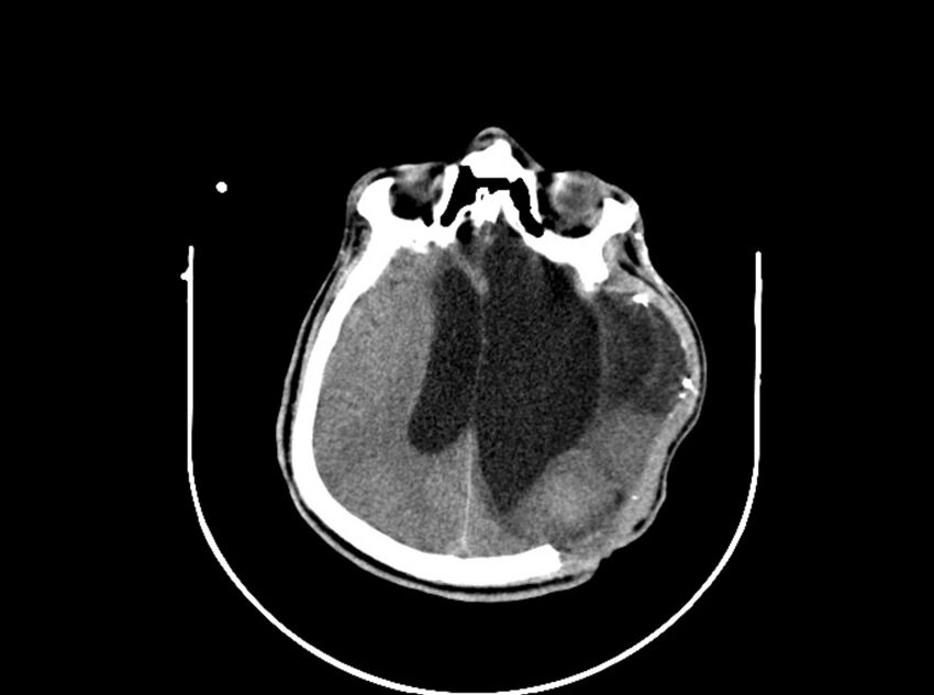 Brain injury by firearm projectile (Radiopaedia 82068-96088 A 138).jpg